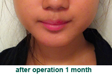 plastic-surgery-chin-augmentation